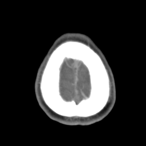 Anterior cerebral artery territory infarct (Radiopaedia 39327-41581 B 9).png
