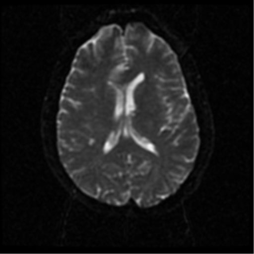 File:Anterior cerebral artery territory infarct (Radiopaedia 39327-41584 Axial DWI 40).png