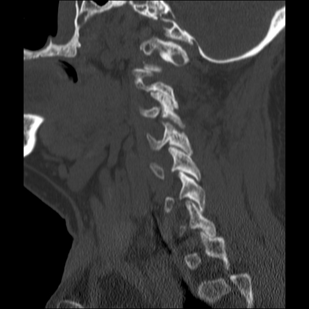 Anterior cervical postdiscectomy arthrodesis (Radiopaedia 32678-33646 Sagittal bone window 58).jpg