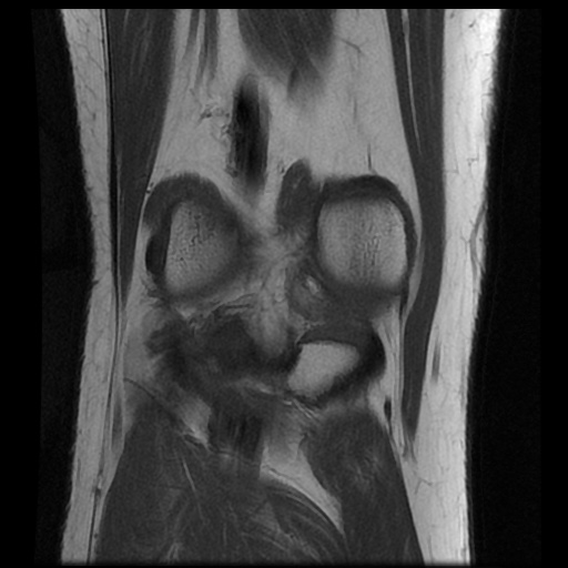 File:Anterior cruciate ligament avulsion fracture (Radiopaedia 58939-66193 Coronal T1 15).jpg