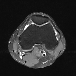 File:Anterior cruciate ligament full thickness tear (Radiopaedia 66268-75467 Axial PD fat sat 10).jpg
