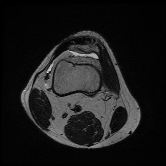File:Anterior cruciate ligament graft tear and bucket-handle tear of medial meniscus (Radiopaedia 75867-87254 Axial T2 24).jpg