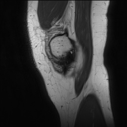 Anterior cruciate ligament rupture and posteromedial corner injury (Radiopaedia 67338-76723 Sagittal PD 27).jpg