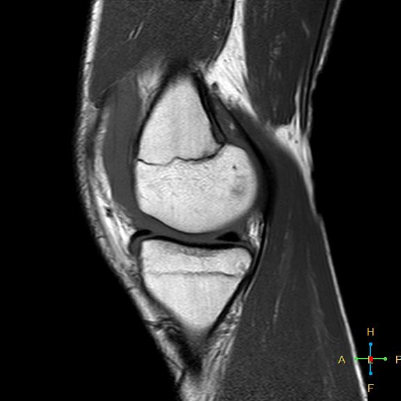 File:Anterior cruciate ligament tear - complete (Radiopaedia 24907-25170 Sagittal T1 13).jpg