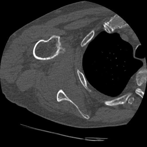 Anterior glenohumeral dislocation with Hill-Sachs lesion (Radiopaedia 62877-71249 Axial bone window 55).jpg