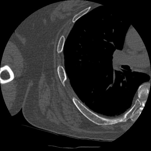 Anterior glenohumeral dislocation with Hill-Sachs lesion (Radiopaedia 62877-71249 Axial bone window 94).jpg