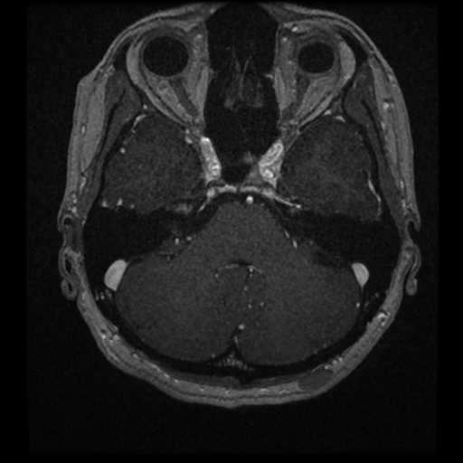 Anterior inferior cerebellar artery vascular loop - type II (Radiopaedia 70991-81209 Axial T1 C+ 43).jpg