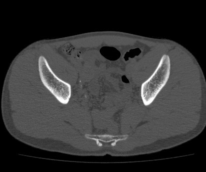 Anterior inferior iliac spine avulsion fracture (Radiopaedia 81312-94999 Axial bone window 41).jpg