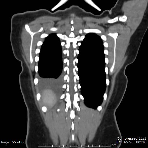 File:Anterior mediastinal B cell Lymphoma (Radiopaedia 50677-56114 B 28).jpg