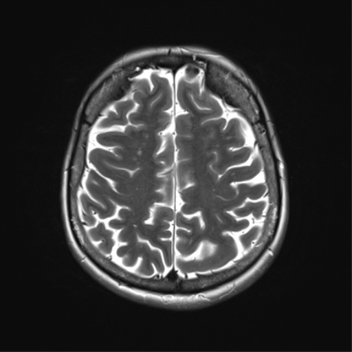 File:Anterior temporal lobe perivascular space (Radiopaedia 40946-43650 Axial T2 29).png