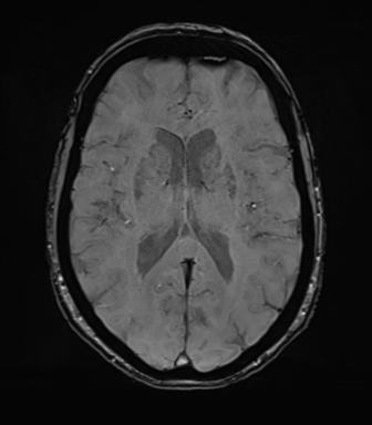 Anterior temporal pole cysts (Radiopaedia 46629-51102 Axial SWI 50).png