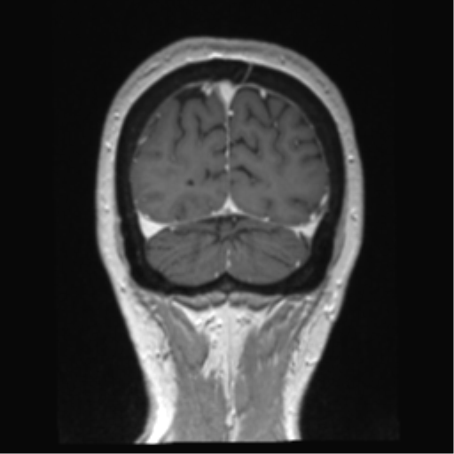 Anterior temporal pole cysts (Radiopaedia 46629-51102 Coronal T1 C+ 29).png