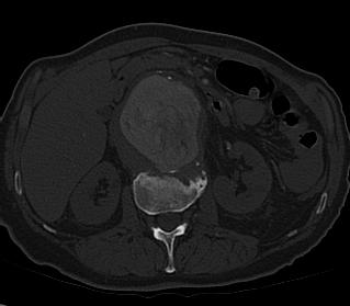 File:Anterior vertebral scalloping (abdominal aortic aneurysm) (Radiopaedia 66744-76067 Axial bone window 16).jpg