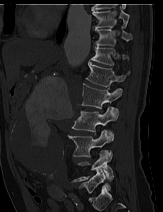 File:Anterior vertebral scalloping (abdominal aortic aneurysm) (Radiopaedia 66744-76067 Sagittal bone window 17).jpg
