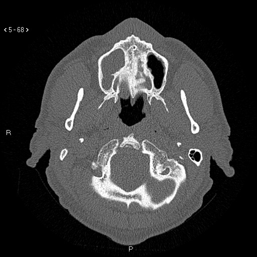 Antrochoanal Polyp (Radiopaedia 70510-80631 Axial bone window 16).jpg