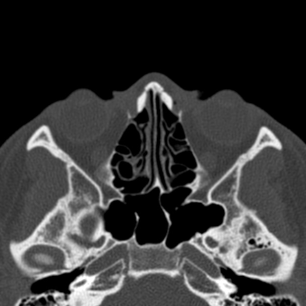 Antrochoanal polyp (Radiopaedia 33984-35202 Axial bone window 44).jpg