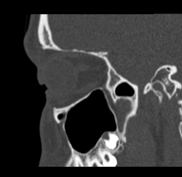 File:Antrochoanal polyp (Radiopaedia 33984-35202 Sagittal bone window 63).jpg