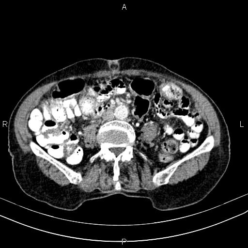 Aortic aneurysm and Lemmel syndrome (Radiopaedia 86499-102554 A 48).jpg