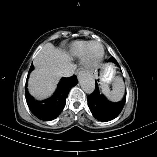 Aortic aneurysm and Lemmel syndrome (Radiopaedia 86499-102554 Axial C+ delayed 9).jpg