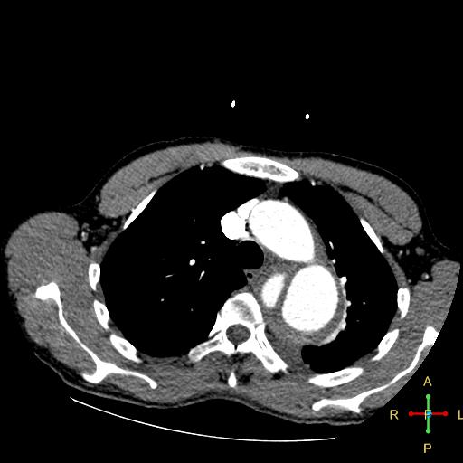 File:Aortic aneurysm and penetrating ulcer (Radiopaedia 23590-23704 A 9).jpg