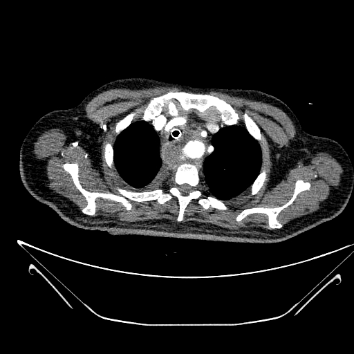 Aortic arch aneurysm (Radiopaedia 84109-99365 B 119).jpg