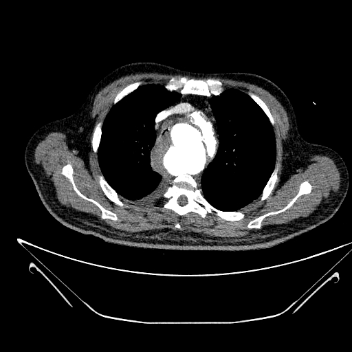 Aortic arch aneurysm (Radiopaedia 84109-99365 B 183).jpg