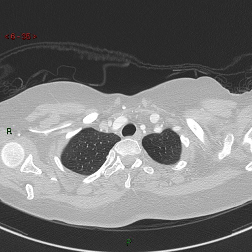 Aortic arch origin of left vertebral artery (Radiopaedia 51520-57286 Axial lung window 35).jpg