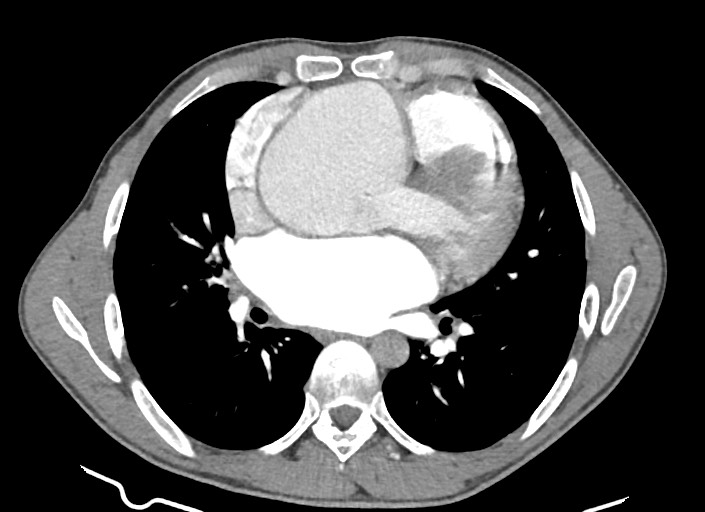 File:Aortic coarctation with aneurysm (Radiopaedia 74818-85828 A 104).jpg