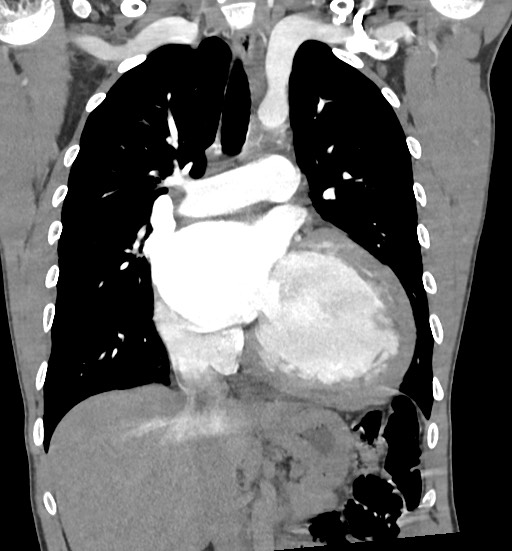 Aortic coarctation with aneurysm (Radiopaedia 74818-85828 C 56).jpg