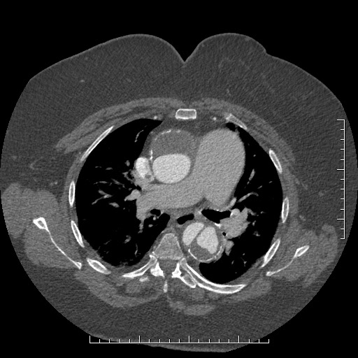 Aortic dissection- Stanford A (Radiopaedia 35729-37268 A 35).jpg