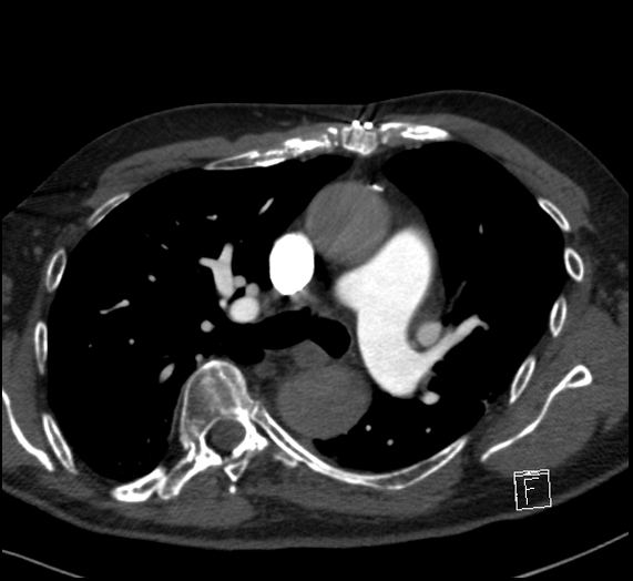 File:Aortic dissection (CTPA) (Radiopaedia 75506-86751 Axial C+ CTPA 59).jpg