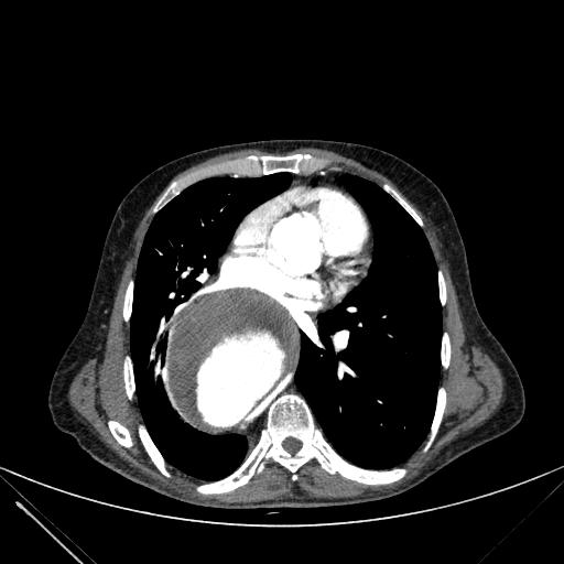 Aortic dissection (Radiopaedia 27466-27665 C+ arterial phase 146).jpg