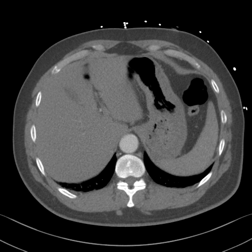 Aortic dissection (Radiopaedia 50763-56234 A 68).png
