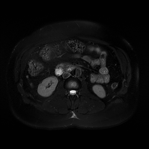 File:Aortic dissection (Radiopaedia 57969-64956 Axial T2 fat sat 36).jpg