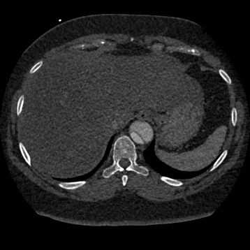 File:Aortic dissection (Radiopaedia 57969-64959 A 268).jpg