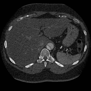 Aortic dissection (Radiopaedia 57969-64959 A 300).jpg