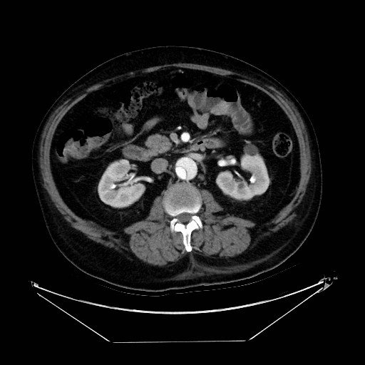 Aortic dissection (Radiopaedia 62562-71000 A 64).jpg