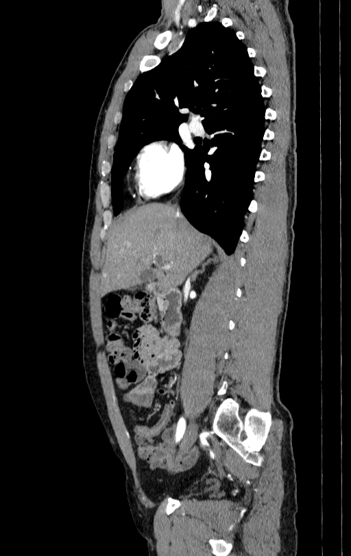 Aortic dissection - Stanford type A (Radiopaedia 83418-98500 B 9).jpg