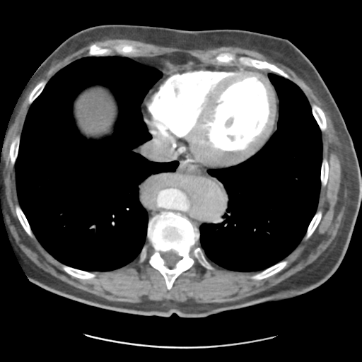 File:Aortic dissection - Stanford type B (Radiopaedia 50171-55512 A 38).png