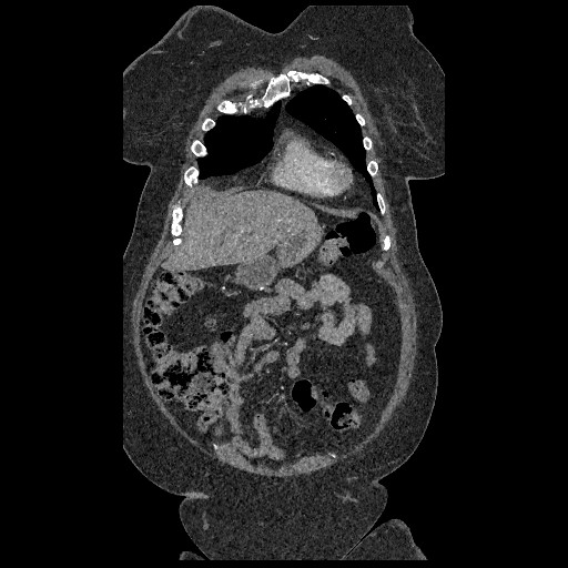 Aortic dissection - Stanford type B (Radiopaedia 88281-104910 B 9).jpg