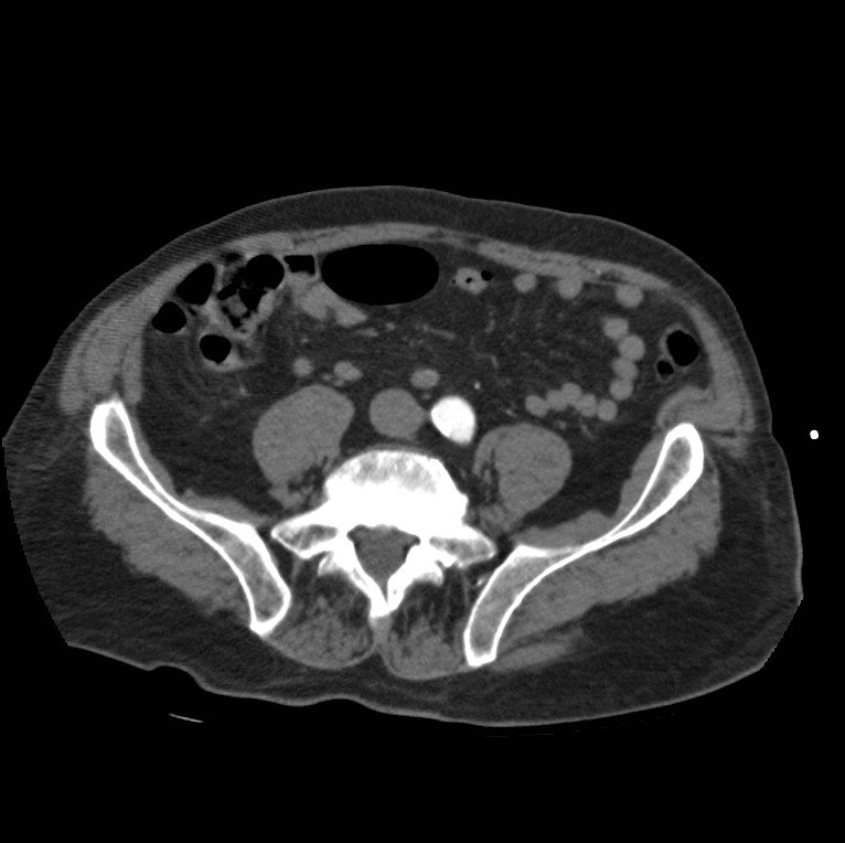 Aortic dissection with rupture into pericardium (Radiopaedia 12384-12647 A 73).jpg