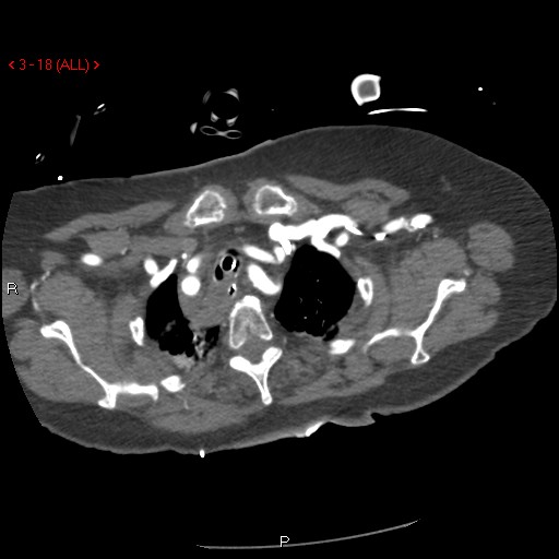 Aortic intramural hematoma (Radiopaedia 27746-28001 A 18).jpg