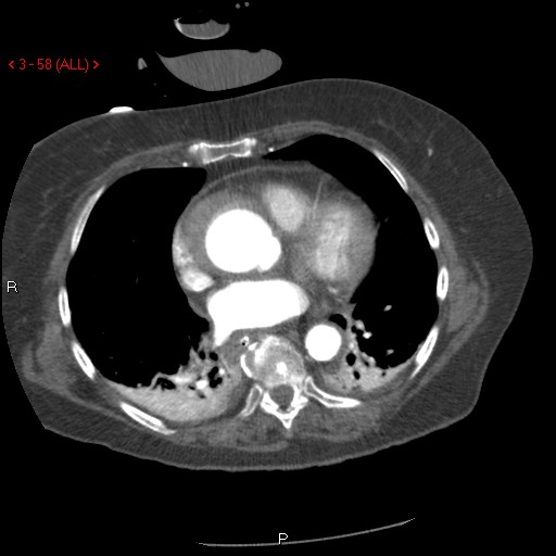 Aortic intramural hematoma (Radiopaedia 27746-28001 A 58).jpg