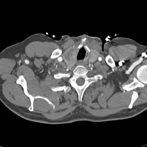 Aortic intramural hematoma (Radiopaedia 31139-31838 B 5).jpg