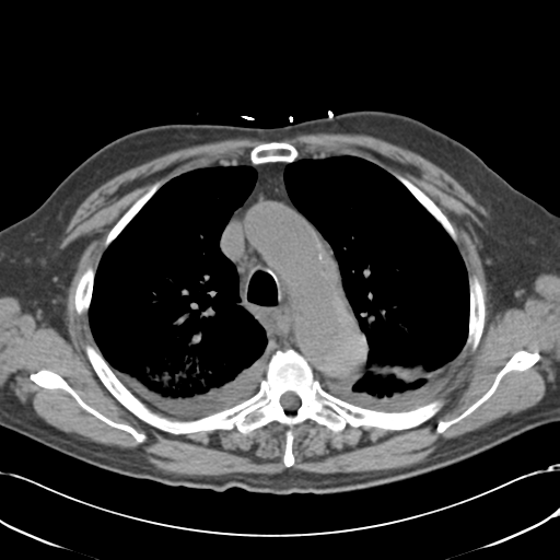 Aortic intramural hematoma (Radiopaedia 34260-35540 Axial non-contrast 20).png