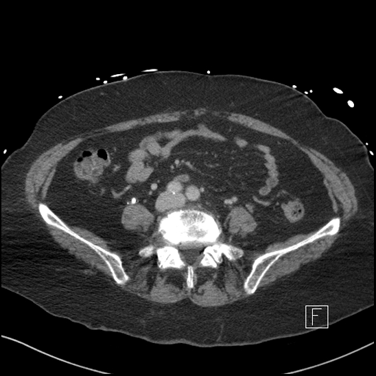 File:Aortic intramural hematoma with dissection and intramural blood pool (Radiopaedia 77373-89491 E 61).jpg