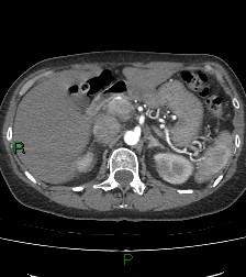 Aortic valve endocarditis (Radiopaedia 87209-103485 C 100).jpg