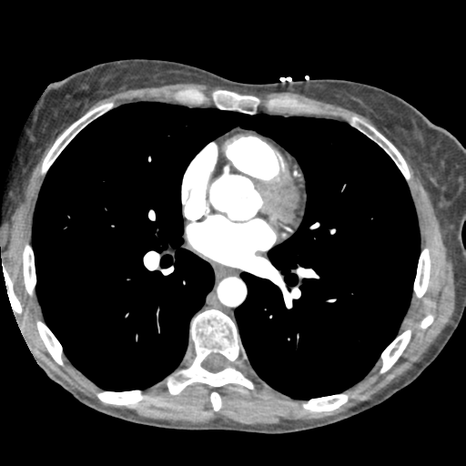 File:Aortic valve non-coronary cusp thrombus (Radiopaedia 55661-62189 A 2).png