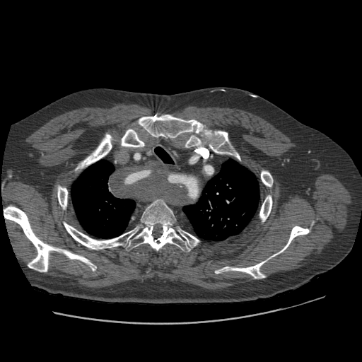 File:Aorto-coronary bypass graft aneurysms (Radiopaedia 40562-43157 A 23).png