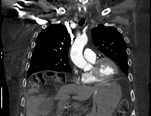 Aortoesophageal fistula with endovascular repair (Radiopaedia 73781-84592 Coronal C+ CTPA 41).jpg